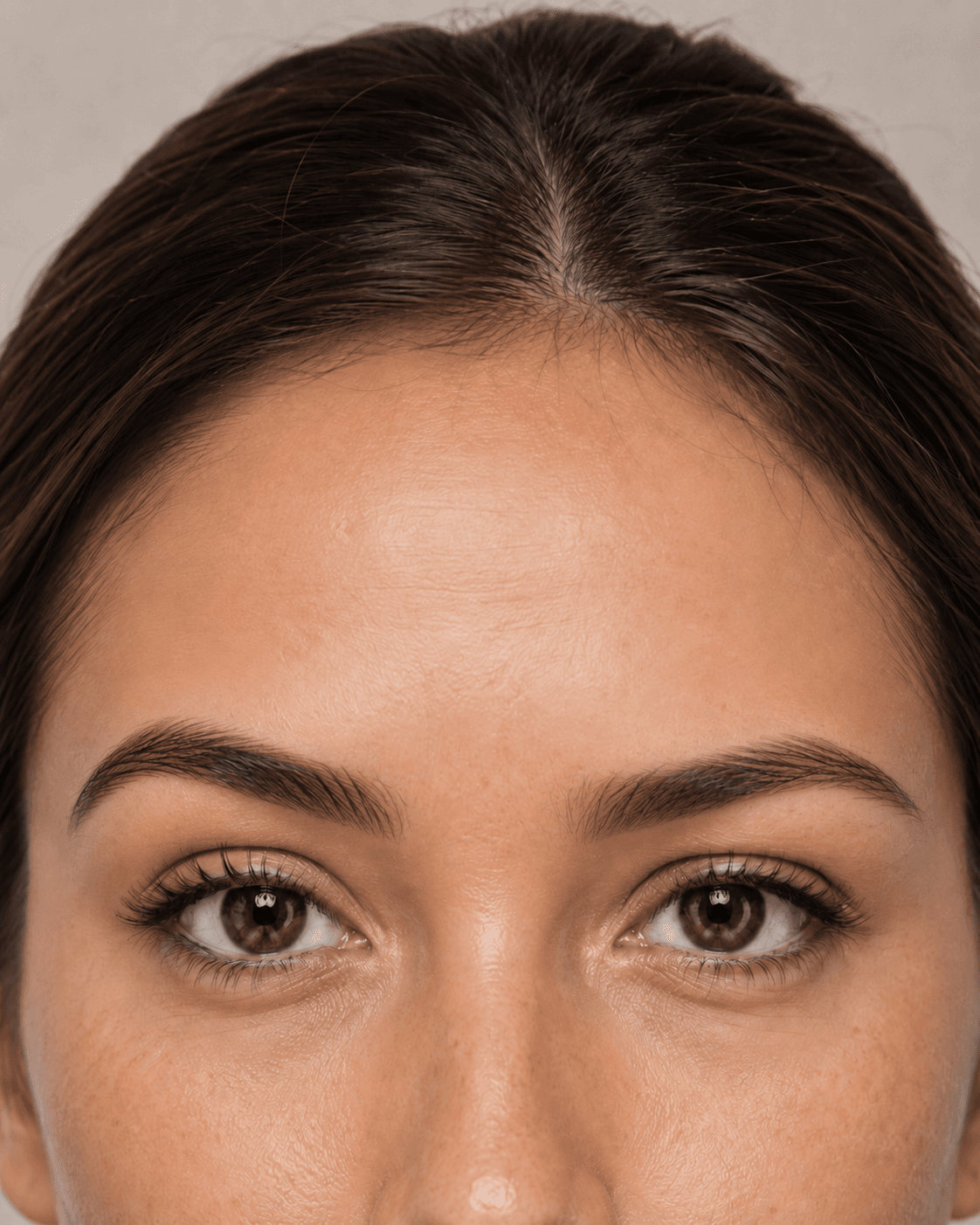 Brow symmetry correction — after