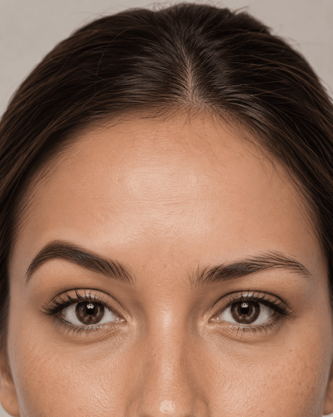 Brow symmetry correction — before